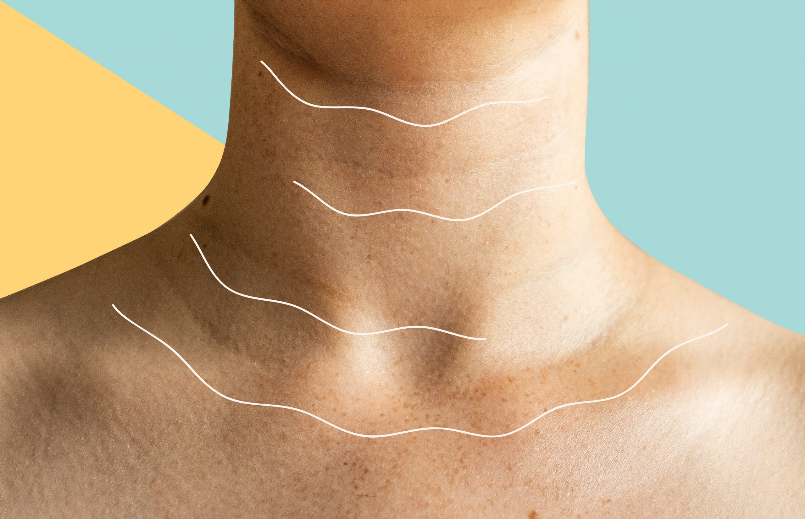 Teck Nech: síndrome que causa rugas no pescoço pode acelerar na quarentena
