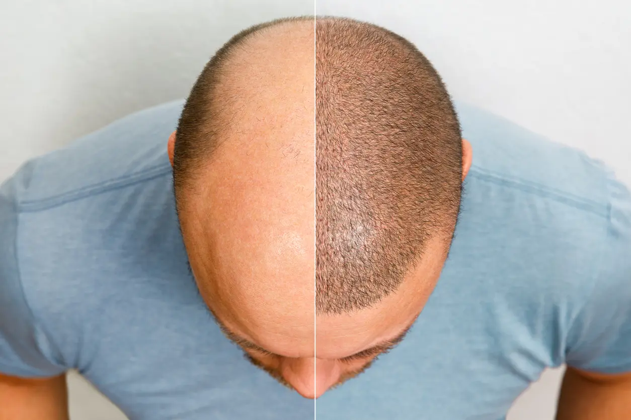 Alopecia Masculina Entenda as Razões e Encontre Soluções Eficazes